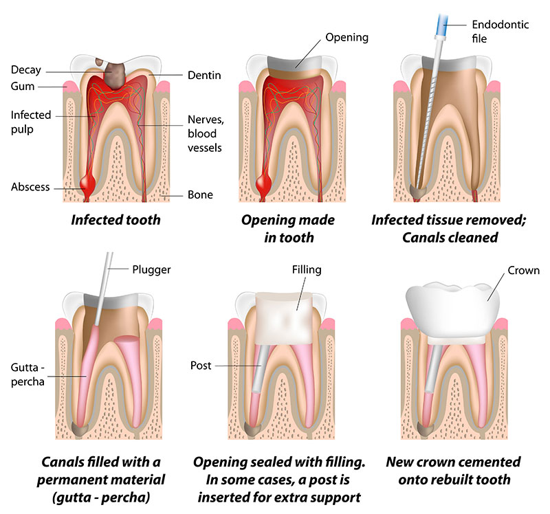 Root Canal Therapy Image