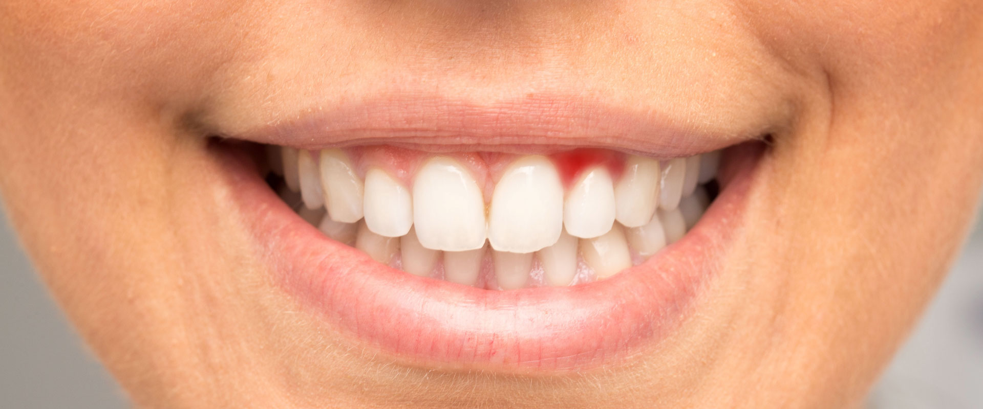 Gum Care / Hygienist Services