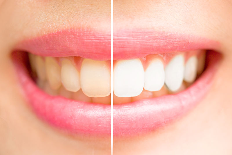 Tooth whitening