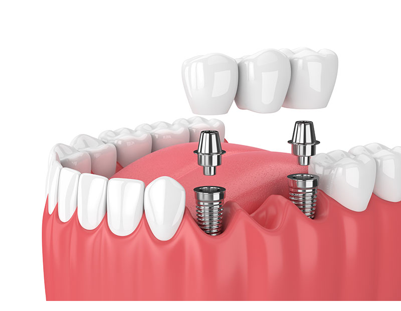 Dental Bridge Dental Bridge