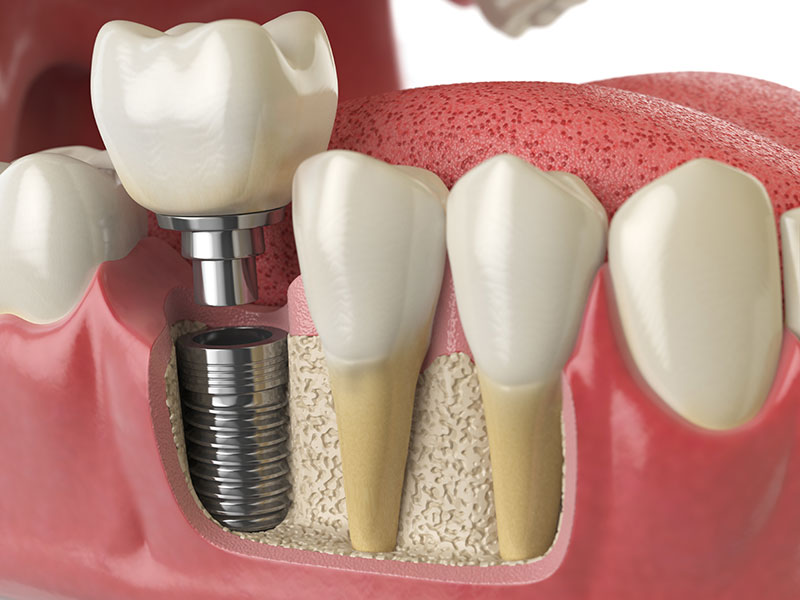 Multiple Dental Implant